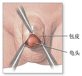 包皮过长症状图片
